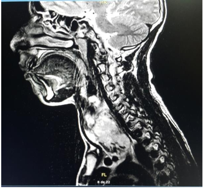 Imagen de Resonancia del Sarcoma de Tiroides en una paciente pediátrico